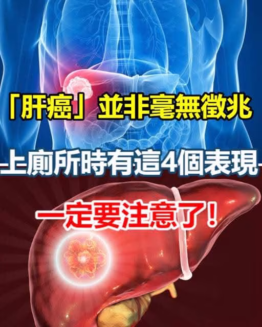 40歲婦女確診肝癌！！醫生提醒：「肝癌」並非毫無徵兆，上廁所時有這4個表現：說明肝已經受傷