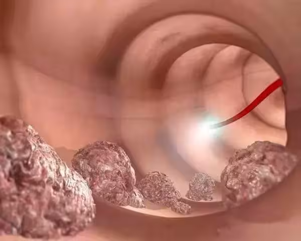 腫瘤專家警告，大便出現3個訊號，恐是大腸癌！！趕快去醫院檢查