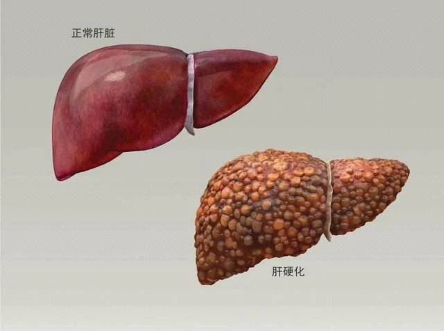 肝開始變硬，頭部會有5個異常，若一個也沒有，說明肝臟還很健康