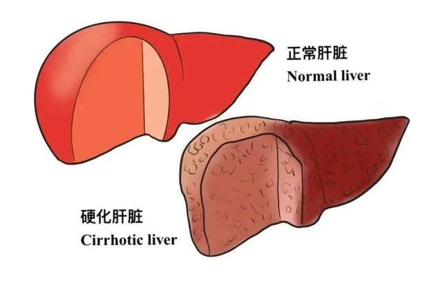 肝開始變硬，頭部會有5個異常，若一個也沒有，說明肝臟還很健康