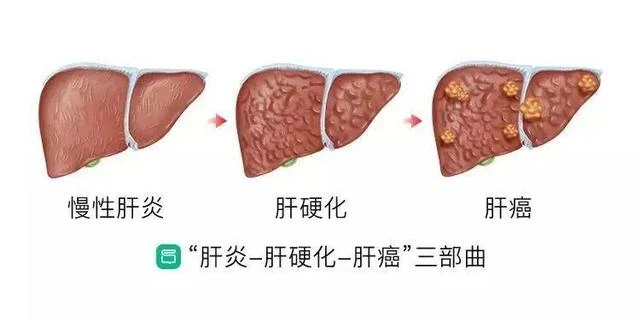 肝開始變硬，頭部會有5個異常，若一個也沒有，說明肝臟還很健康