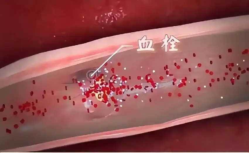 提醒：心梗初期可能不是胸悶，而是頻繁出現這4個癥狀，一定警惕