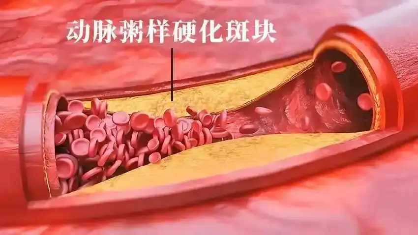 提醒：心梗初期可能不是胸悶，而是頻繁出現這4個癥狀，一定警惕