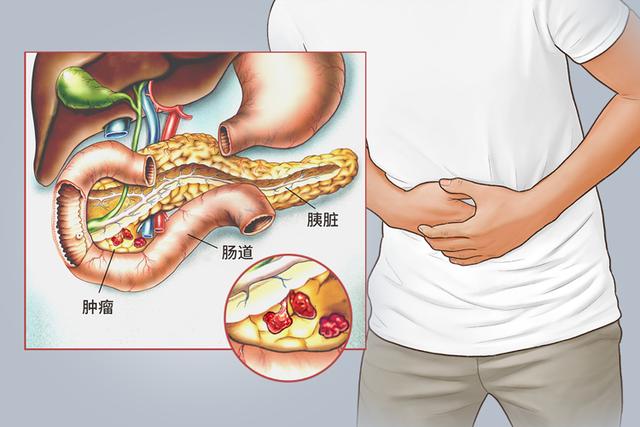 51歲男子每天大便兩三次，確診胰腺癌！6種異常或是身體「警報」