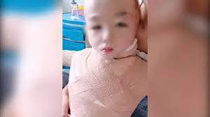 跌進油鍋！3歲童「全身被炸爛」慘叫　母崩潰：只剩五官