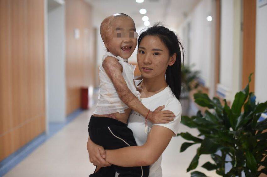 跌進油鍋！3歲童「全身被炸爛」慘叫　母崩潰：只剩五官