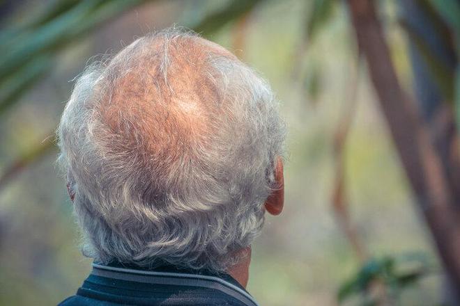 白頭髮突然增多，可能不是因為老了，而是跟缺乏這3種營養有關