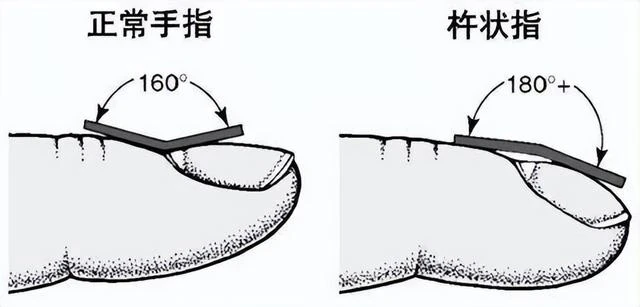 體內有癌，手指先知！提醒：手指出現這些症狀，可能是疾病的信號