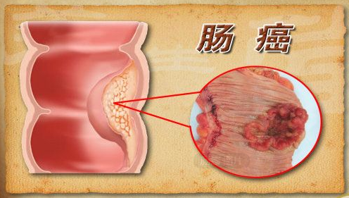 這3種癌被稱為「夫妻癌」，提醒:夫妻一人出現，另一半要趕緊檢查！