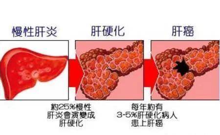 肝不好，腳知道！腳部若出現3個「異常」，提示要養肝了，堅持2事