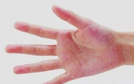 「體內有癌」手腳先知！手腳出現5個「異常」要警惕癌症來臨　尤其是手指有這癥兆「小心肺癌」！