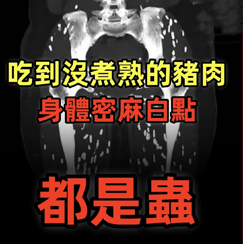 患者因為吃下沒煮熟豬肉，感染了「囊蟲病」，接受CT掃描時，體內布滿了寄生蟲死後留下的鈣化囊腫。