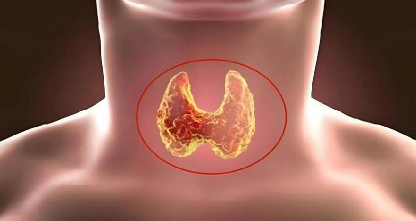 胰臟開始癌變,不是看痛不痛! 醫師:若出現6個症狀或已患癌