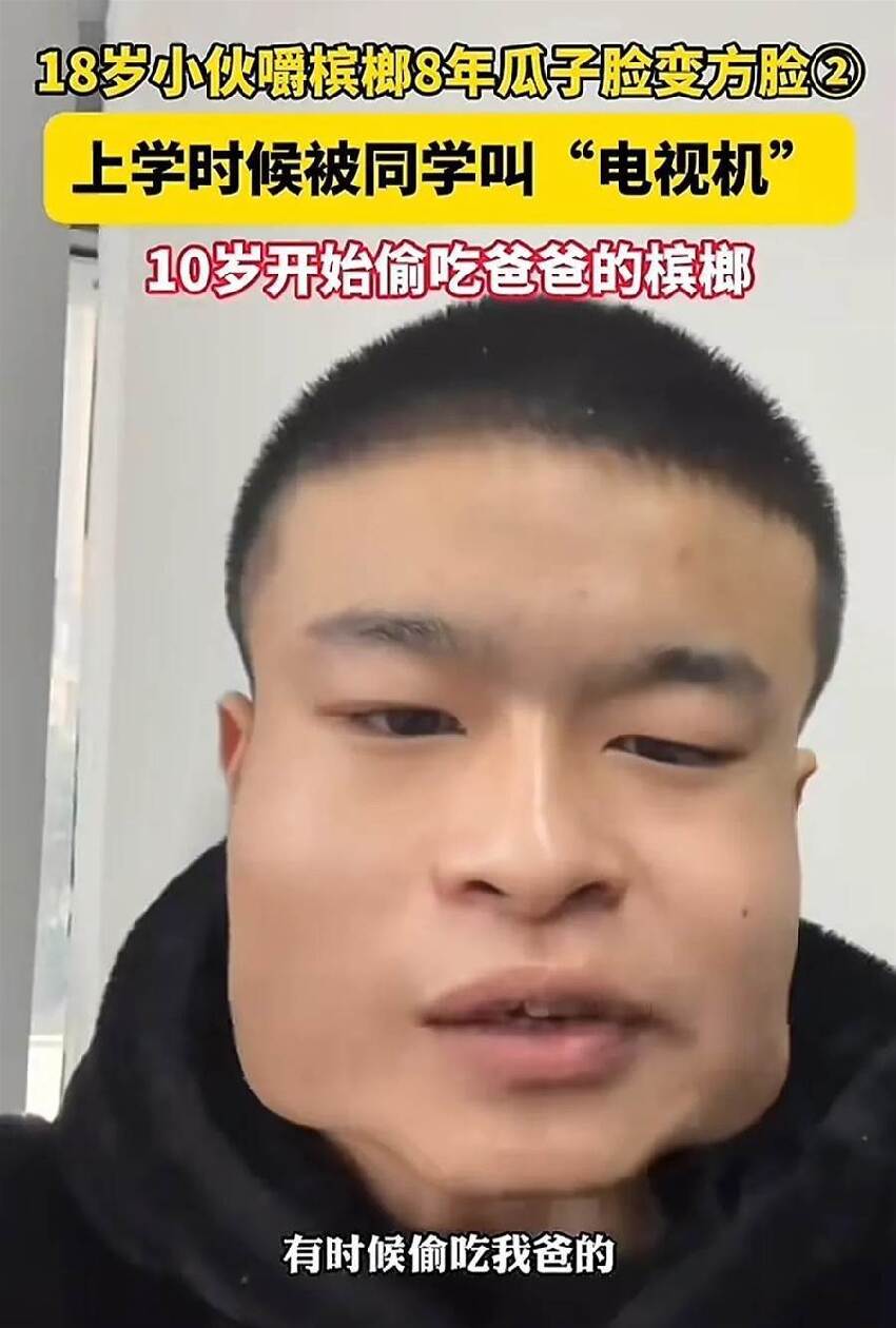 18歲少年嚼檳榔8年！瓜子臉慘變「方塊臉」，網驚：以為是特效