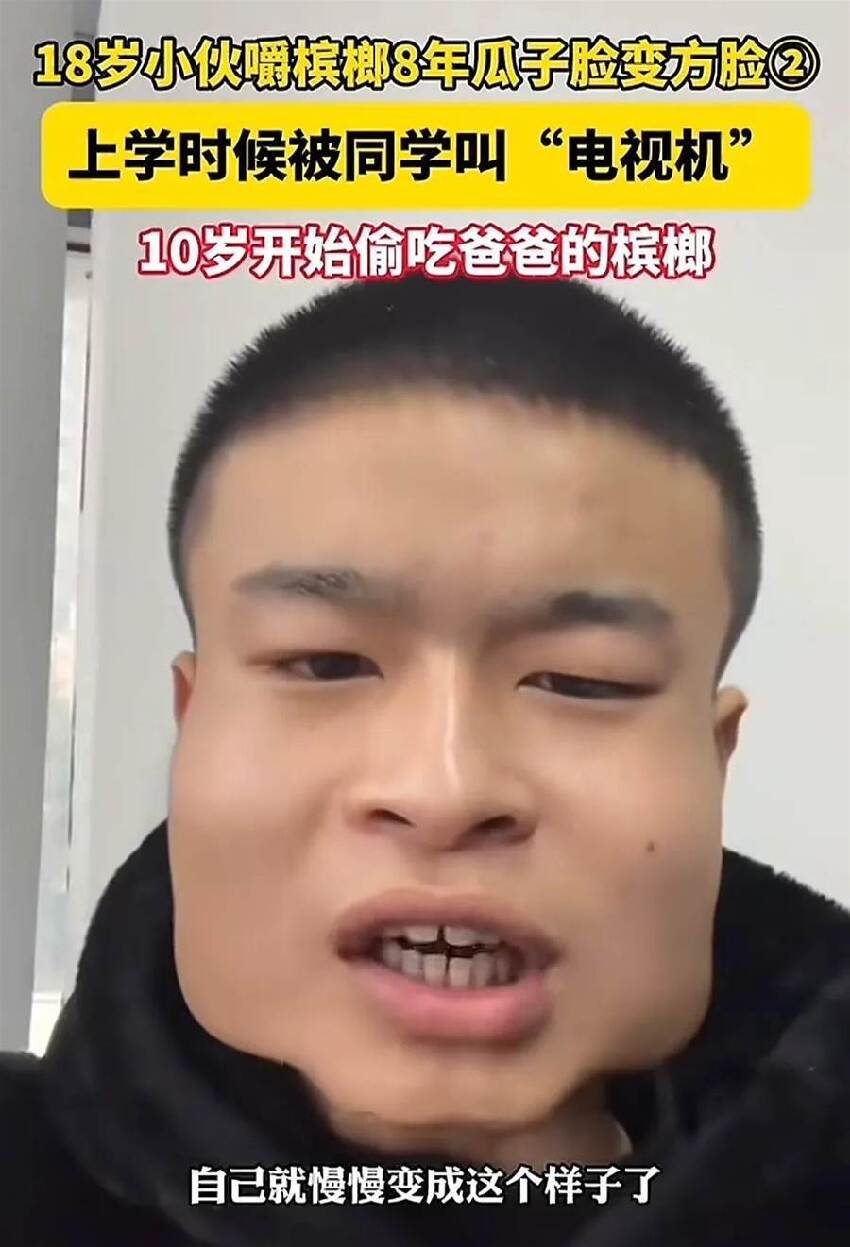 18歲少年嚼檳榔8年！瓜子臉慘變「方塊臉」，網驚：以為是特效