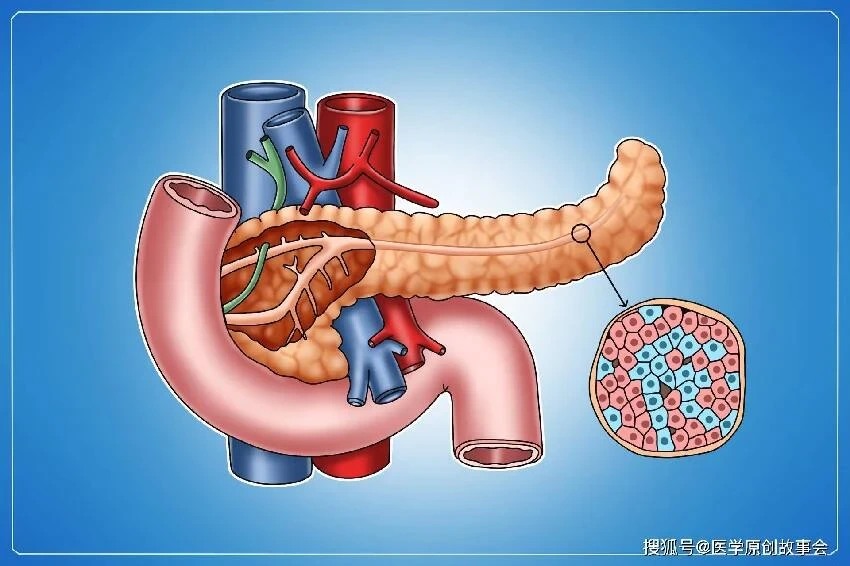 胰腺癌：從確診到死亡僅僅3個月，提醒：4個癥狀，可能是胰腺在求救！