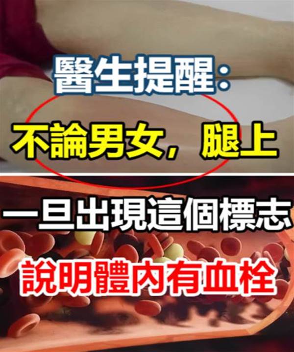 醫生提醒：不論男女，腿上一旦出現這個標志，說明體內有血栓