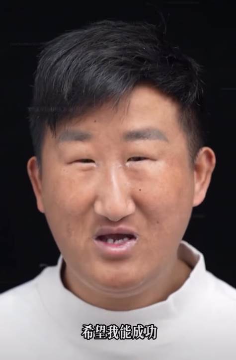 五官超擠！他靠「超小眼睛」狂吸百萬粉，下定決心「去動割雙眼皮」術后他哭了：救不回來了