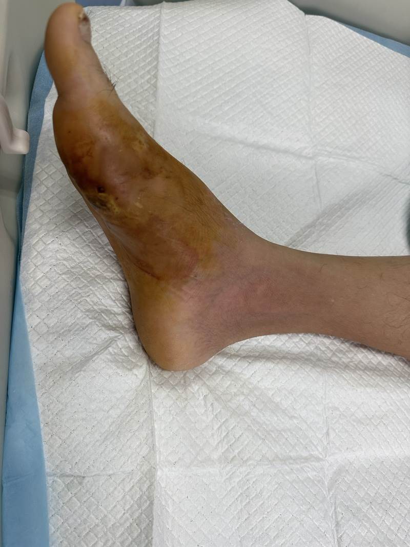 一腳踩中牙簽，男子差點「爛」掉整隻腳！醫生提醒：這種感染太兇險「小傷口」千萬別大意