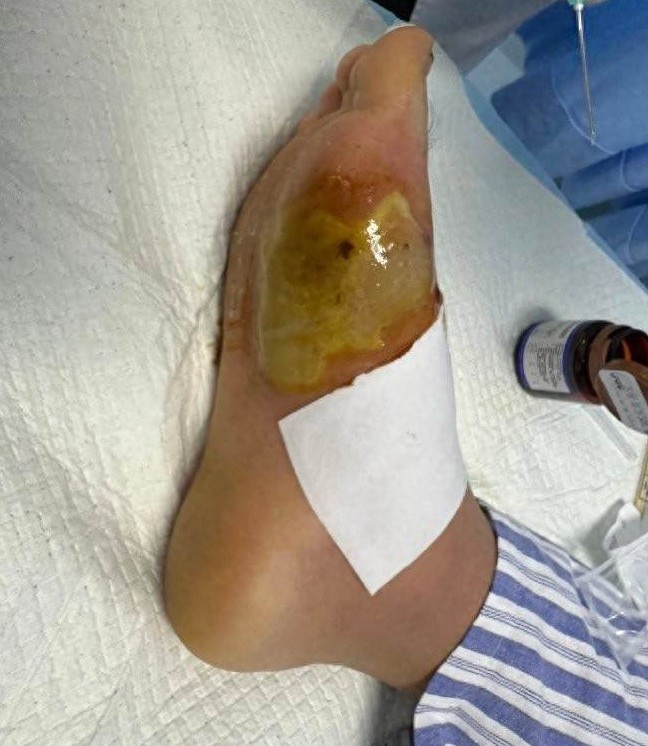 一腳踩中牙簽，男子差點「爛」掉整隻腳！醫生提醒：這種感染太兇險「小傷口」千萬別大意