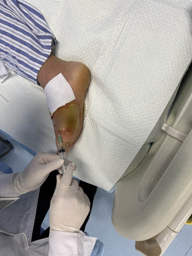 一腳踩中牙簽，男子差點「爛」掉整隻腳！醫生提醒：這種感染太兇險「小傷口」千萬別大意