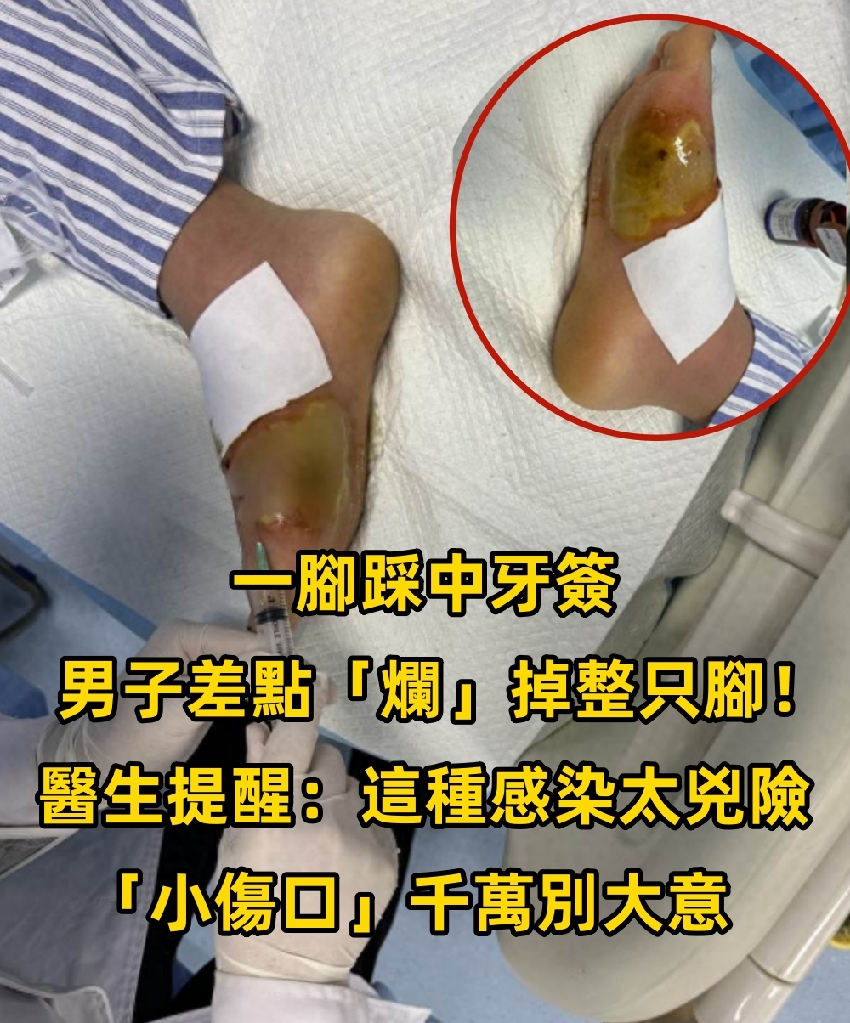 一腳踩中牙簽，男子差點「爛」掉整隻腳！醫生提醒：這種感染太兇險「小傷口」千萬別大意