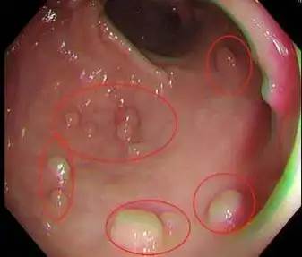 有沒有大腸瘜肉「上廁所就知道」！醫生警告：身體最早「4大前兆」別拖成癌