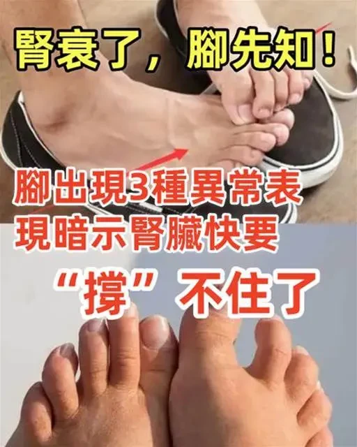 腎衰了 腳先知！腳出現3種異常表現，暗示腎臟快要「撐」不住了