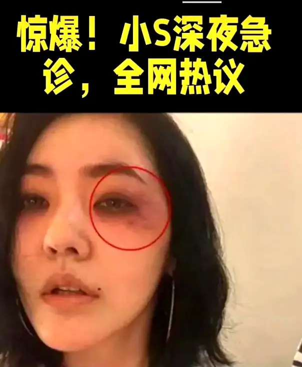 小S深夜急診驚現青紫傷痕，神秘黑帽男子隨行引猜測