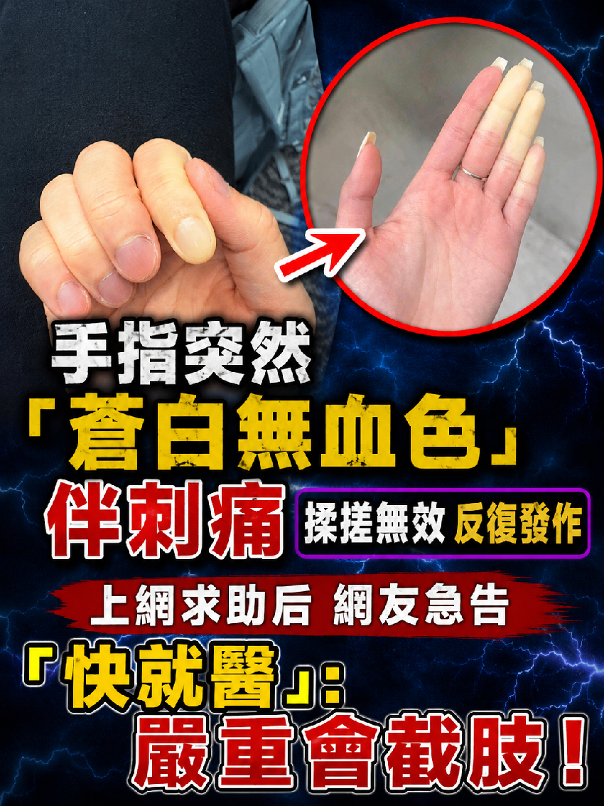 手指突然「蒼白無血色」伴刺痛，揉搓無效反復發作，上網求助后網友急告「快就醫」：嚴重會截肢！