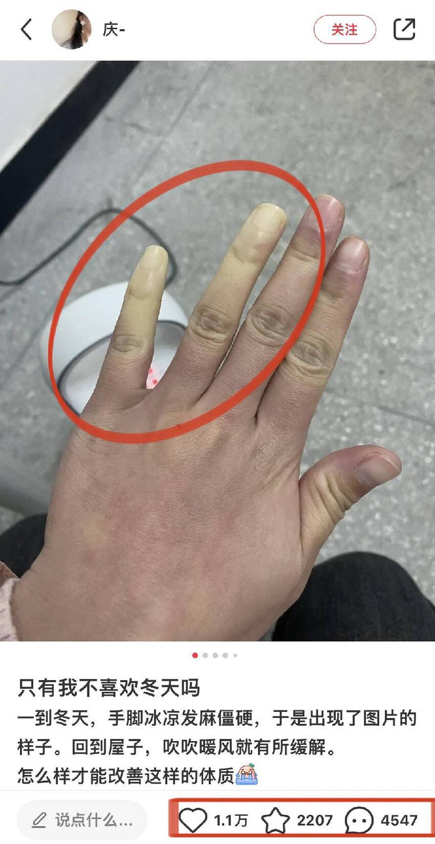 手指突然「蒼白無血色」伴刺痛，揉搓無效反復發作，上網求助后網友急告「快就醫」：嚴重會截肢！