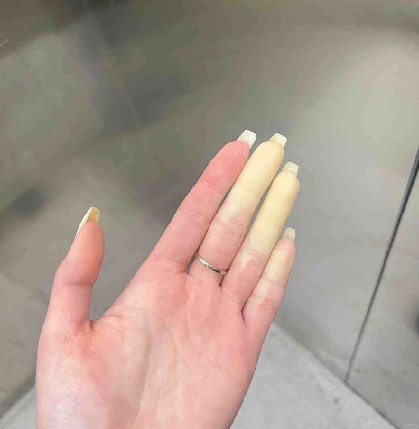 手指突然「蒼白無血色」伴刺痛，揉搓無效反復發作，上網求助后網友急告「快就醫」：嚴重會截肢！