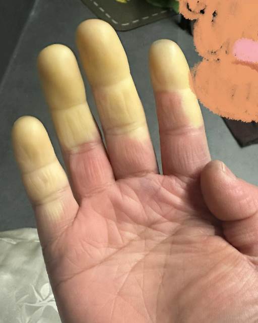 手指突然「蒼白無血色」伴刺痛，揉搓無效反復發作，上網求助后網友急告「快就醫」：嚴重會截肢！