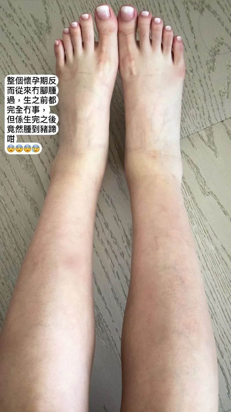 產後雙腳腫成豬蹄！TVB美女花旦罕見自爆丑照！稱生前身材完美！