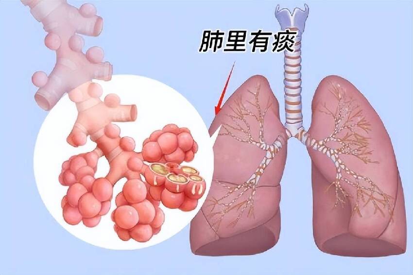 嗓子里總有痰，痰多吐不完？中醫教你3招，輕鬆切斷「生痰之源」