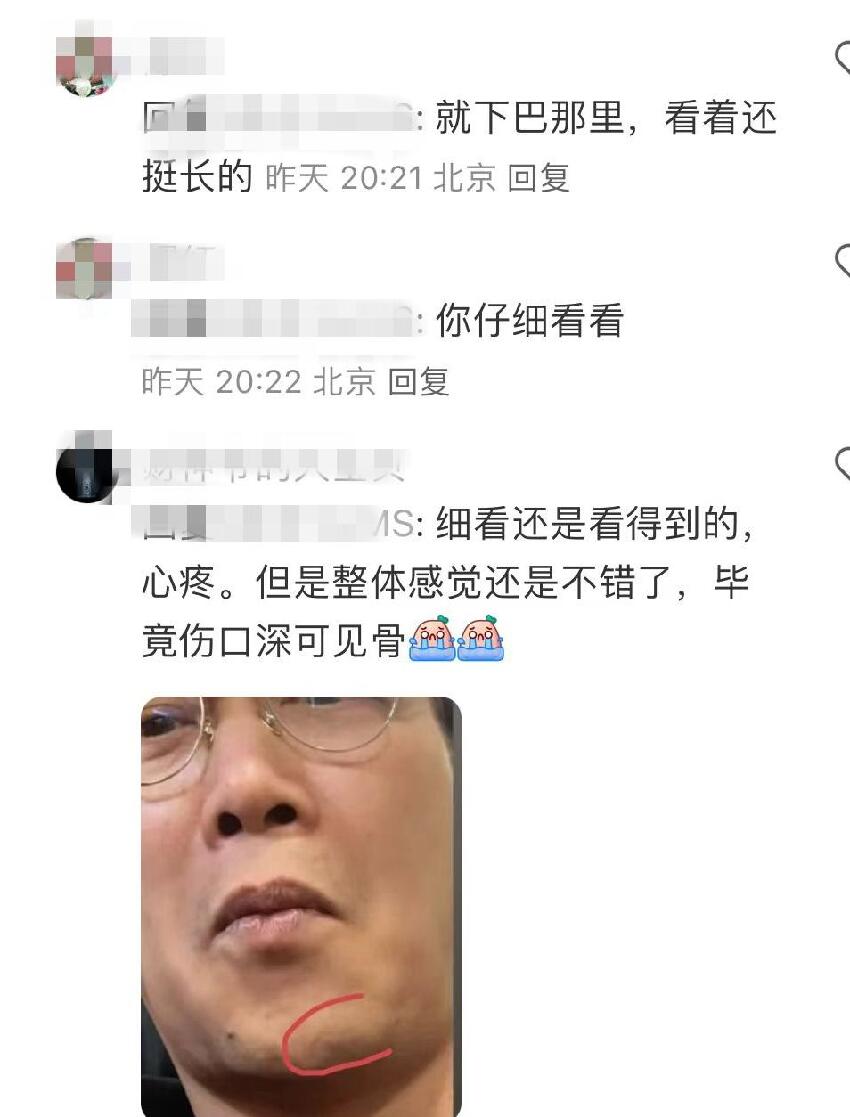 陳奕迅臉上縫了30針的傷口首曝光，好長一條疤痕，幸好恢復得不錯