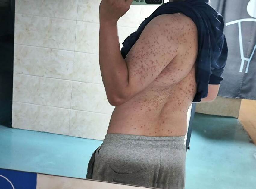 男子運動后皮膚長滿「膿包」半夜送去急診，醫生怒斥：這個習慣再不改，皮膚全爛光！