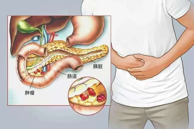 胰腺有癌，吃飯知道？吃飯時出現的3個異樣，或是胰腺癌來臨信號！