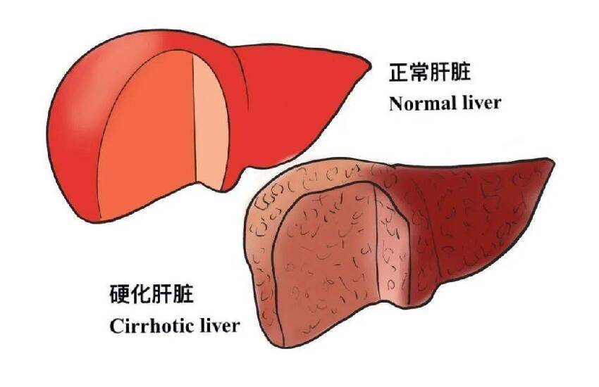 肝開始變硬，頭部會有5個異常，若一個也沒有，說明肝臟還很健康！