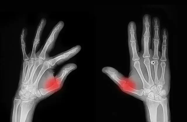 經常掰手指，老了會得關節炎？這樣響沒事，又響又痛可能是這些病