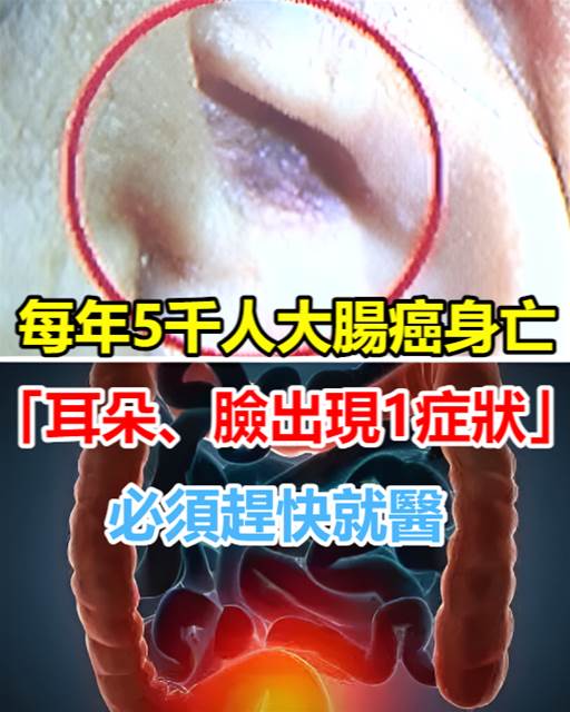 每年5千人大腸癌身亡「耳朵、臉出現1癥狀」必須快就醫！