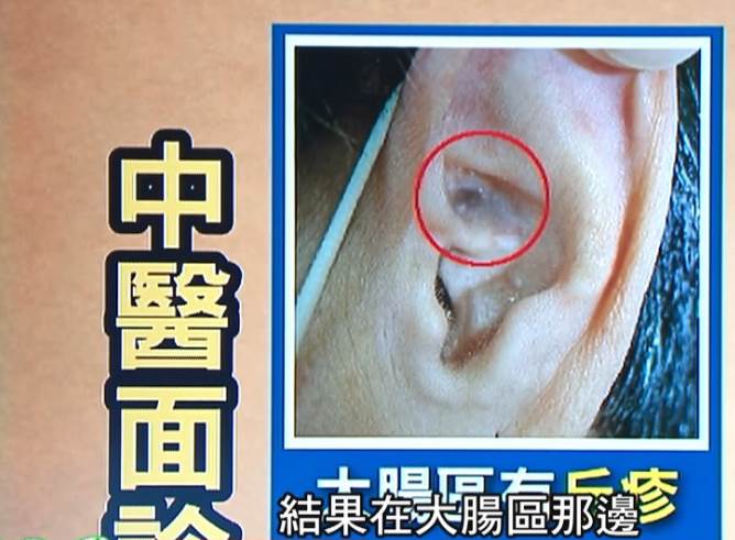 每年5千人大腸癌身亡「耳朵、臉出現1癥狀」必須快就醫！