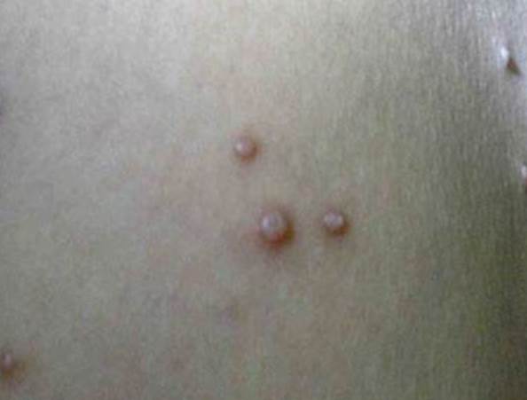 女子PO洗澡后肩膀「恐怖疙瘩」照！網急喊就醫，醫看后臉色大變：你家都可能被「傳染」！