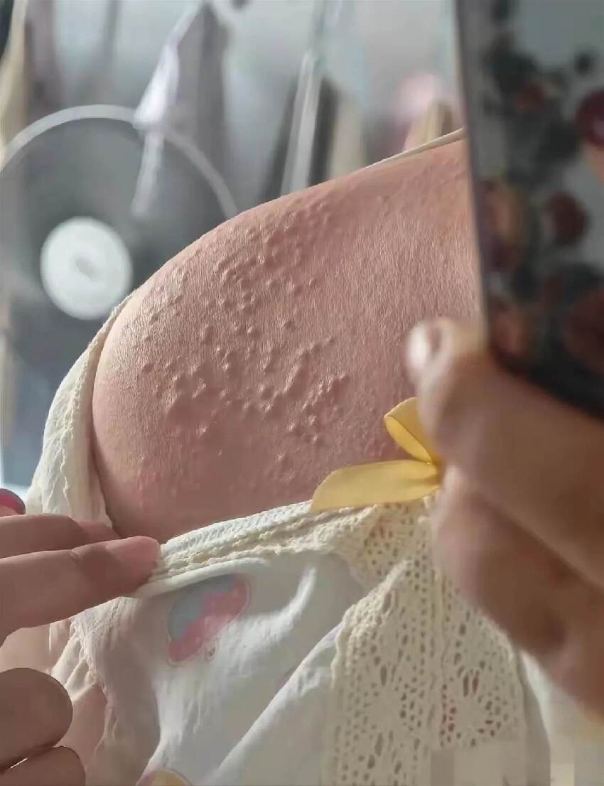女子PO洗澡后肩膀「恐怖疙瘩」照！網急喊就醫，醫看后臉色大變：你家都可能被「傳染」！