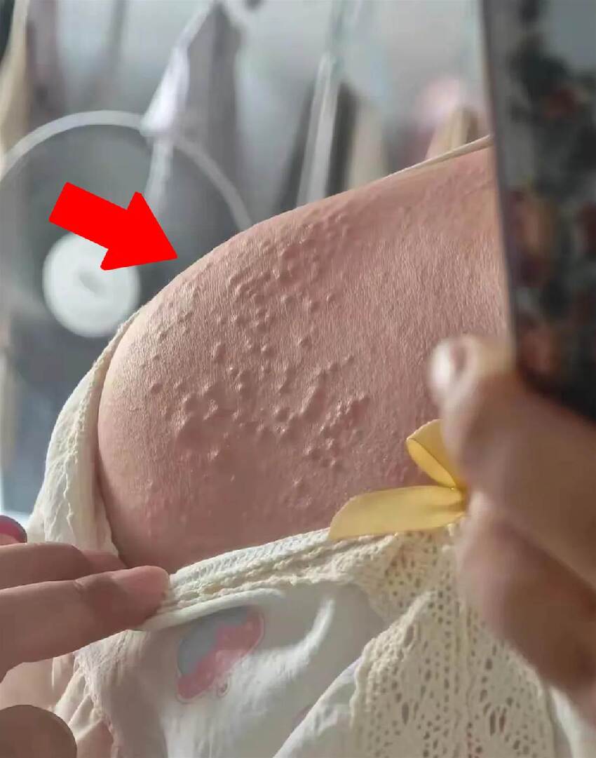 女子PO洗澡后肩膀「恐怖疙瘩」照！網急喊就醫，醫看后臉色大變：你家都可能被「傳染」！
