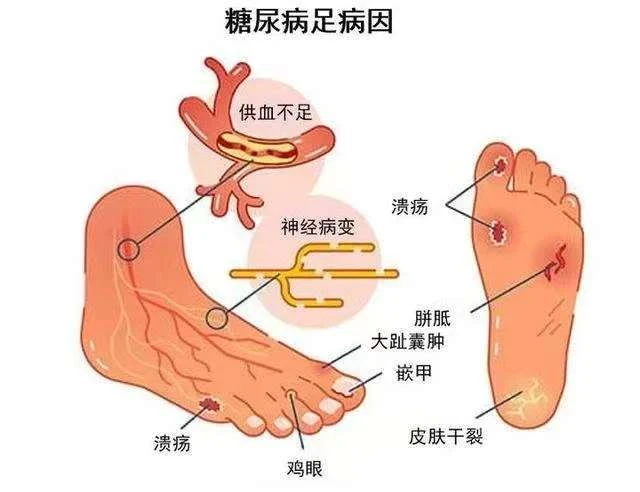 糖尿病是皮膚病？提醒：若皮膚出現3個症狀，小心血糖高了！