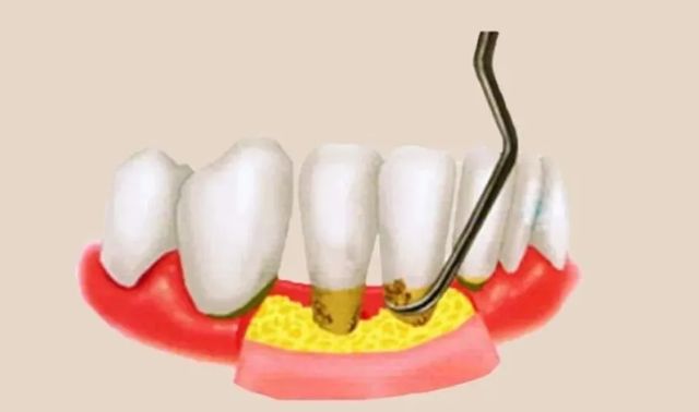 牙結石不要花錢去洗牙！用一個土方法，自己家裡輕鬆去除牙結石！牙結石全部清