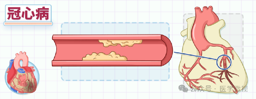 冠心病是怎麽回事？哪些人容易得？40歲開始要注意了