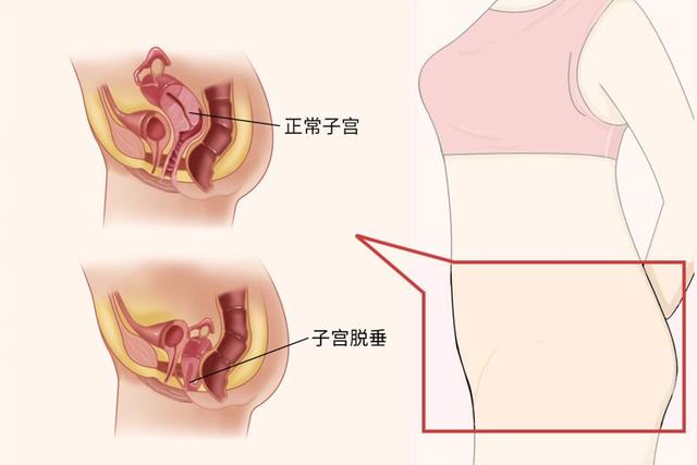 「陰挺」是什麼病？主要原因是什麼？女性要遠離這種「社交癌」