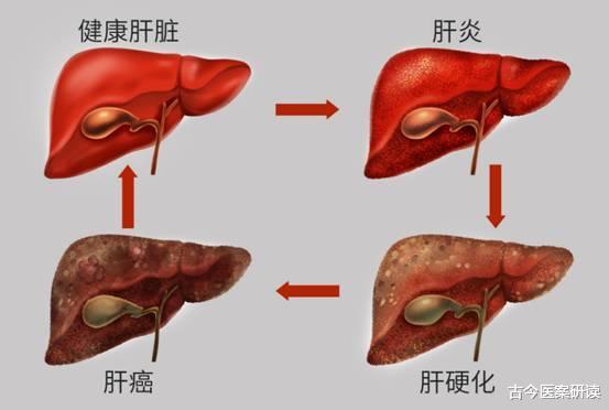 肝病年輕化！28歲新婚女子「肝臟照出腫瘤」人生全走樣　「一查生活作息」醫生怒斥：早起2件事太要命